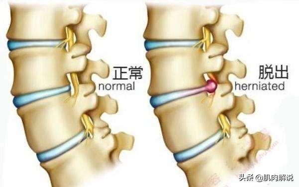 腰椎间盘突出症的最新研究及治疗进展综述